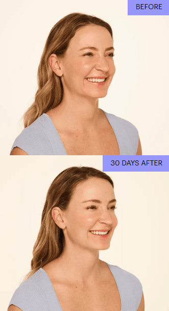 Before and after neuromodulator treatment, smoother skin at 30 days