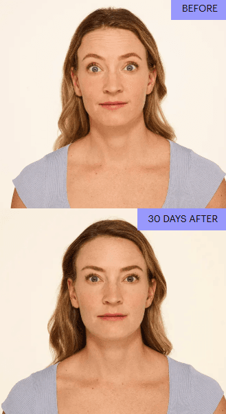 Before and after front view with relaxed forehead lines at 30 days