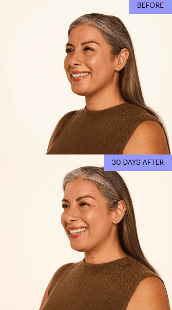 Before and after profile view with relaxed lines at 30 days